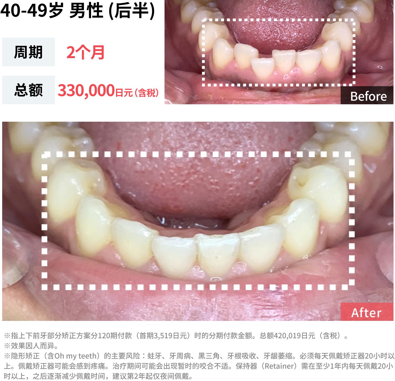 牙齿拥挤的病例照片