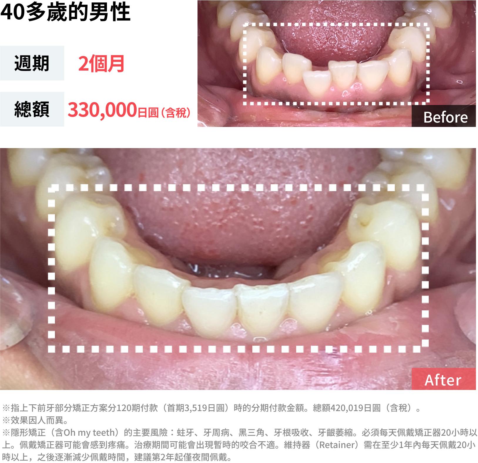 牙齒歪斜的案例照片