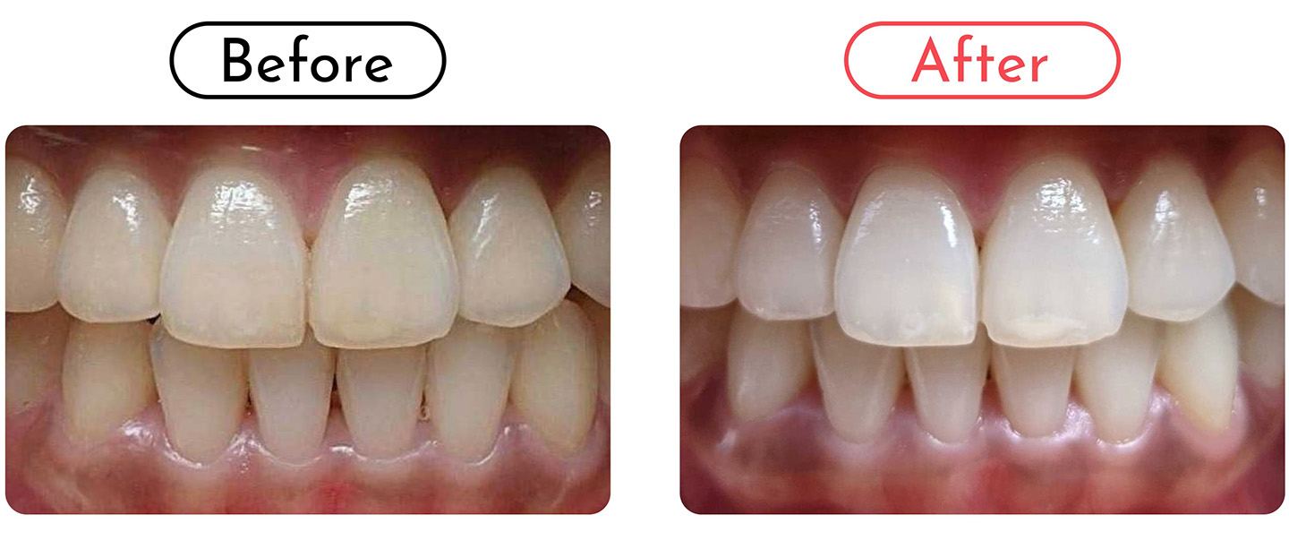Whitening